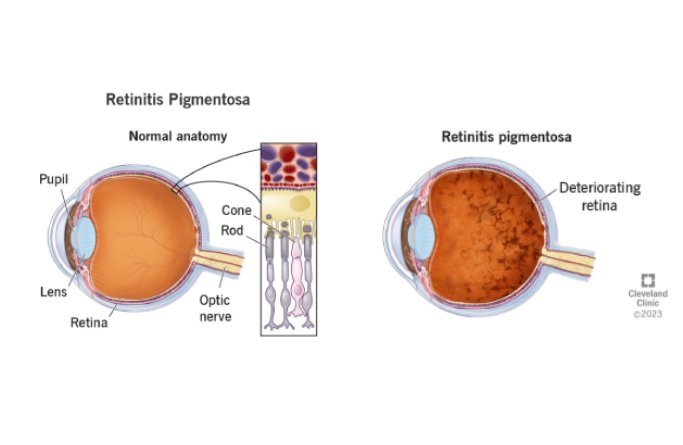 RETINA